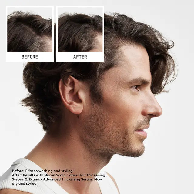 Nioxin Scalp + Hair Thickening System 2 PROGRESSED  THINNING NATURAL / UNTREATED HAIR