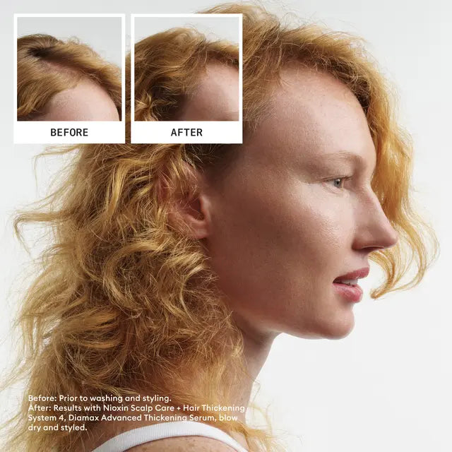 Nioxin Scalp + Hair Thickening System 4 Trio Pack PROGRESSED THINNING COLOURED / DRY / DAMAGED HAIR